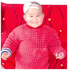 Hydrocephalus adoption